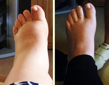 Orteva Anti-Schwell Strümpfe